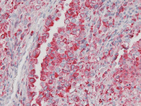 Lung adenocarcinoma stained with Napsin A antibody.