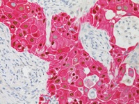 Squamous cell carcinoma stained with Lung Squamous-2 (p63 + CK5) multiplex cocktail