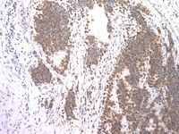Ewing's sarcoma stained with CD99 antibody
