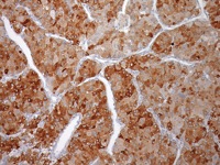 Liver cancer stained with Glypican-3 antibody