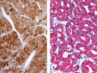 (L) HCC stained with Glypican-3 + CK19 (R) Cholangiocarcinoma stained with Glypican-3 + CK19