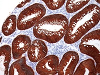 Colon cancer stained with MOC-31 antibody