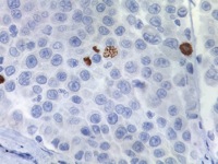 Melanoma stained with Phospho-Histone H3 antibody