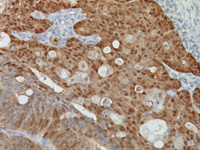 Colon cancer stained with β-Catenin antibody.