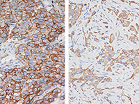 Breast cancer stained with GLUT-1 antibody
