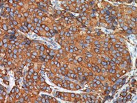 Breast cancer stained with Heat Shock Protein 27 antibody