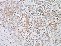 Prostate cancer stained with c-Myc antibody