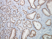 Prostate cancer stained with NKX3.1 antibody