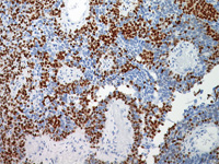 Metastatic melanoma stained with MiTF antibody