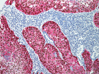 Lung squamous cell carcinoma stained with p63 (DAB) + TRIM29 (FR) Cocktail