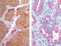 (L) Lung SqCC and Lung adenocarcinoma (R) stained Desmoglein 3 (DAB) + Napsin A (FR)