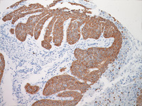 Lung squamous cell carcinoma stained with CK5 antibody