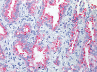 Lung adenocarcinoma stained with Napsin A antibody