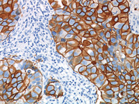 Betazoid DAB Chromogen Kit staining breast cancer with c-erbB-2