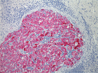 Vulcan Fast Red Chromogen Kit staining melanoma with S100