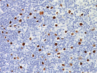 Epstein-Barr Encoded RNA (EBER) Probe - Staining Hodgkin's Lymphoma