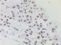 (Positive) amplified HER2/neu at 40x