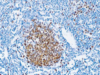 Ki-67 stain using Biocare’s Diva Decloaker buffer for HIER