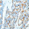Neuroendocrine tumor stained with Chromogranin A antibody