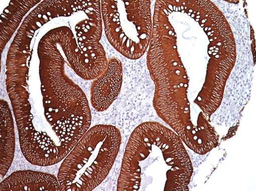 Colon cancer stained with Pan Cytokeratin [AE1/AE3] antibody.