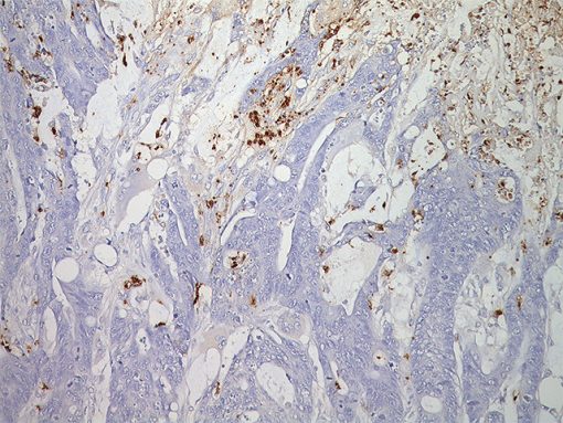 Colon cancer stained with Myeloperoxidase antibody