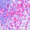 Hodgkin’s Lymphoma stained with CD30 (Ki-1)
