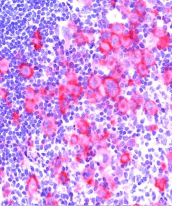 Hodgkin’s Lymphoma stained with CD30 (Ki-1)