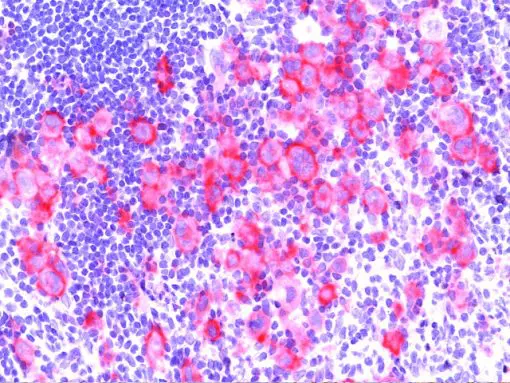 Hodgkin’s Lymphoma stained with CD30 (Ki-1)