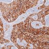 Breast cancer stained with Cytokeratin LMW (8/18) Antibody