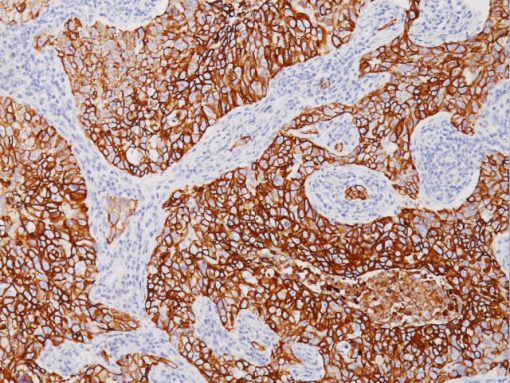 Breast cancer stained with Cytokeratin LMW (8/18) Antibody