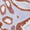 Colon cancer stained with Cytokeratin 20 antibody (CK20)