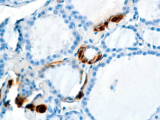 Thyroid stained with Calcitonin antibody