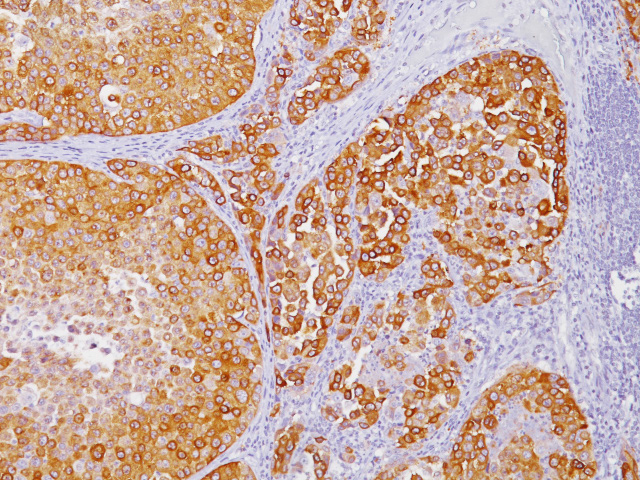 Melanoma stained with MART-1 antibody Cocktail