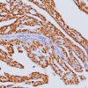 Breast cancer stained with Estrogen Receptor mouse antibody (ER) [6F11]