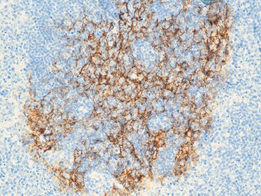 Mantle cell lymphoma stained with Residual CD23 antibody