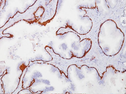 Prostate stained with Cytokeratin 5/6 antibody (CK5/6)