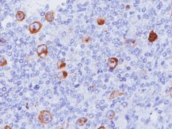 Hodgkin’s lymphoma stained with Epstein-Barr Virus antibody