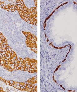 Lung (L) and Prostate (R) stained with Cytokeratin HMW [34βE12]