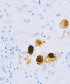 CMV infected tissue stained with Cytomegalovirus antibody