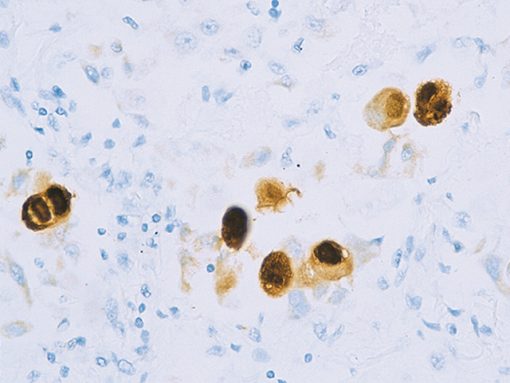 CMV infected tissue stained with Cytomegalovirus antibody