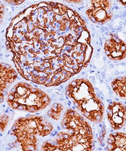 Renal cell carcinoma stained with CD10 antibody