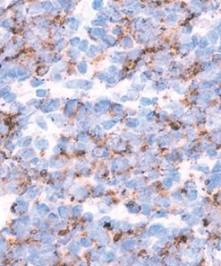 ALCL stained with TIA-1 antibody