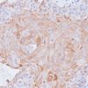 Lung squamous cell carcinoma stained with Cytokeratin 17 antibody (CK17)