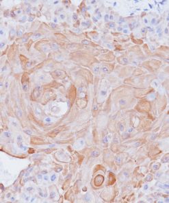 Lung squamous cell carcinoma stained with Cytokeratin 17 antibody (CK17)