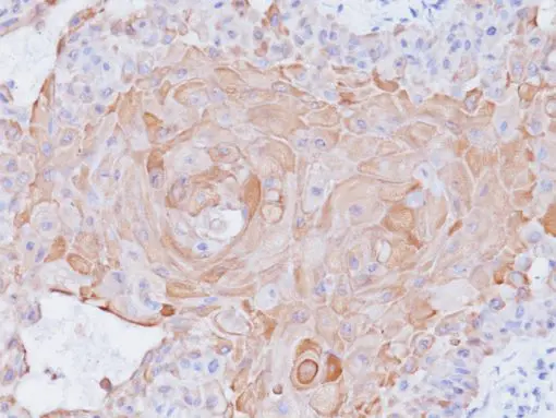 Lung squamous cell carcinoma stained with Cytokeratin 17 antibody (CK17)