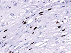 Cervix stained with HPV Broad Spectrum Antibody