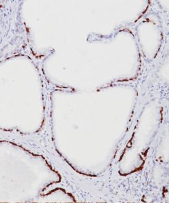 Prostate stained with HMW CK + p63 antibody