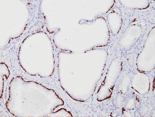 Prostate stained with HMW CK + p63 antibody