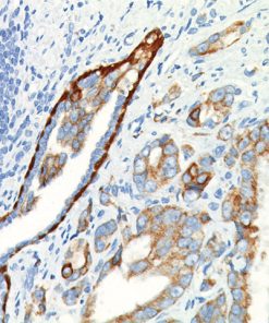 Prostate cancer stained with CK5/14 + p63 + p504s antibody