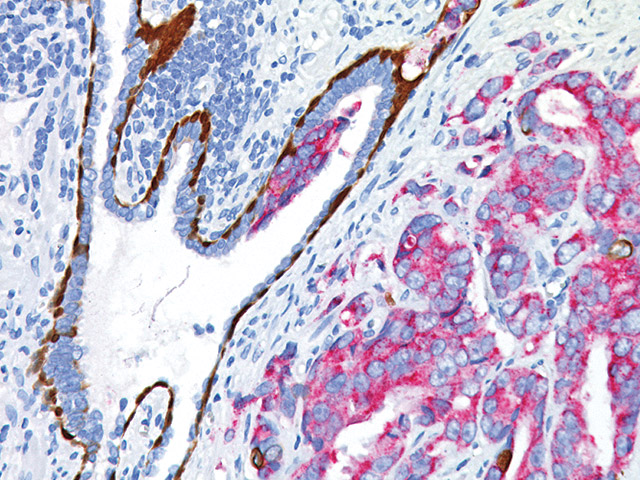 Prostate cancer and prostatic intraepithelial neoplasia stained with PIN-4, CK5/14, p63 (DAB), P504S (FR)